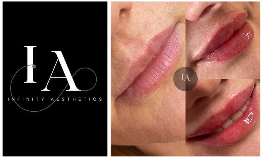 Image 6: Enhance Your Lips with 1.1ml Filler and Expert Consultation