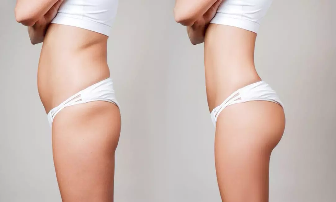 Jusqu'à 30% de remise sur Cryothérapie chez BODY LIFT  31