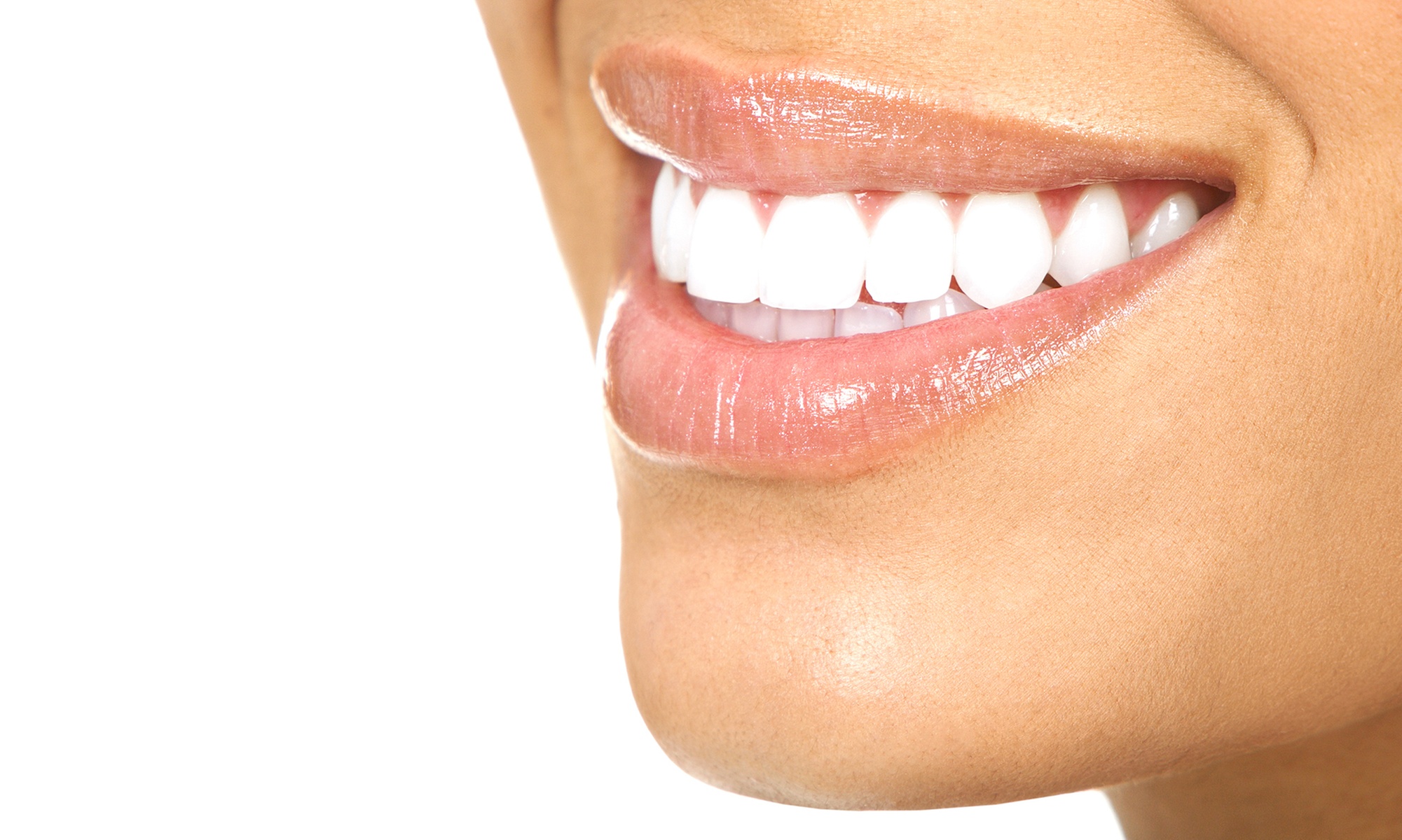Up to 66% Off on Teeth Whitening - In-Office - at Modern Smile