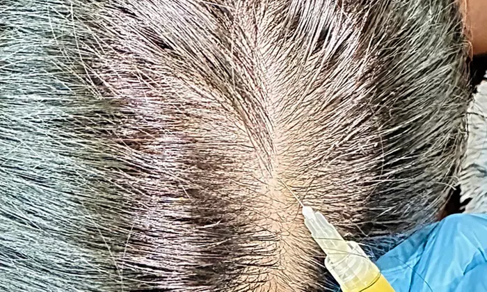 Up to 60% Off on Microneeding with PRP at Sunshine Glow MedSpa - Second Medium