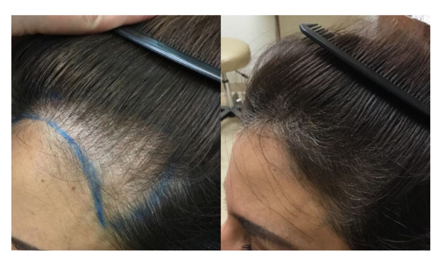 Image 7: 1, 2, 3, or 6 Face Revitalization or Hair Restoration PRP Sessions