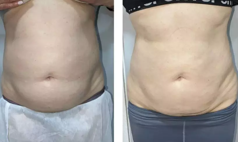 Sculpt Your Dream Body: Mechanical Lymphatic Drainage Massage 