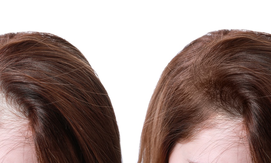 Image 1: Personalized Hair Care Consult or Hair Loss Consultation + Minoxidil