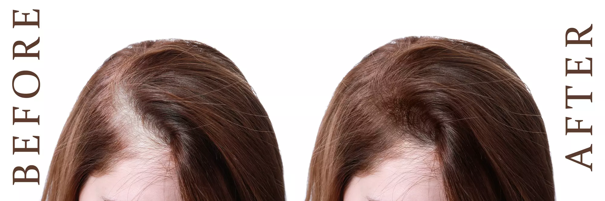 Personalized Hair Care Consultation or Hair Loss Consultation + Minoxidil at SpringCare (Up to 51% Off) - Primary Image