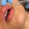 Image 1: Up to 50% Off Juvéderm Injections at Alliance Health Choice