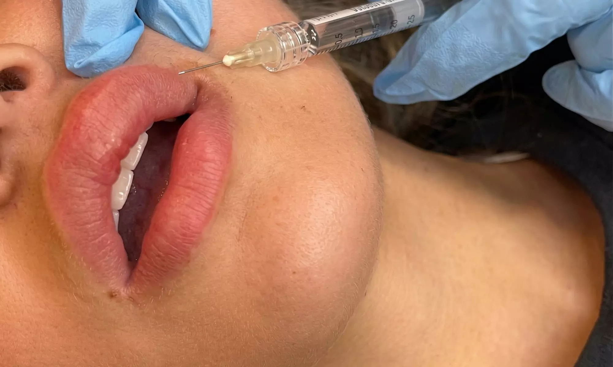 Up to 50% Off Juvéderm Injections at Alliance Health Choice