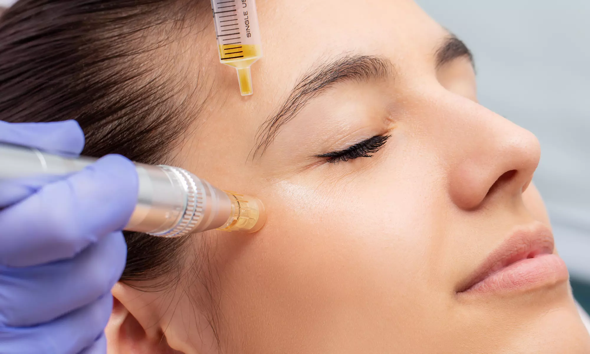 Up to 54% Off on Micro-Needling at Skinlab Medspa - Primary Image