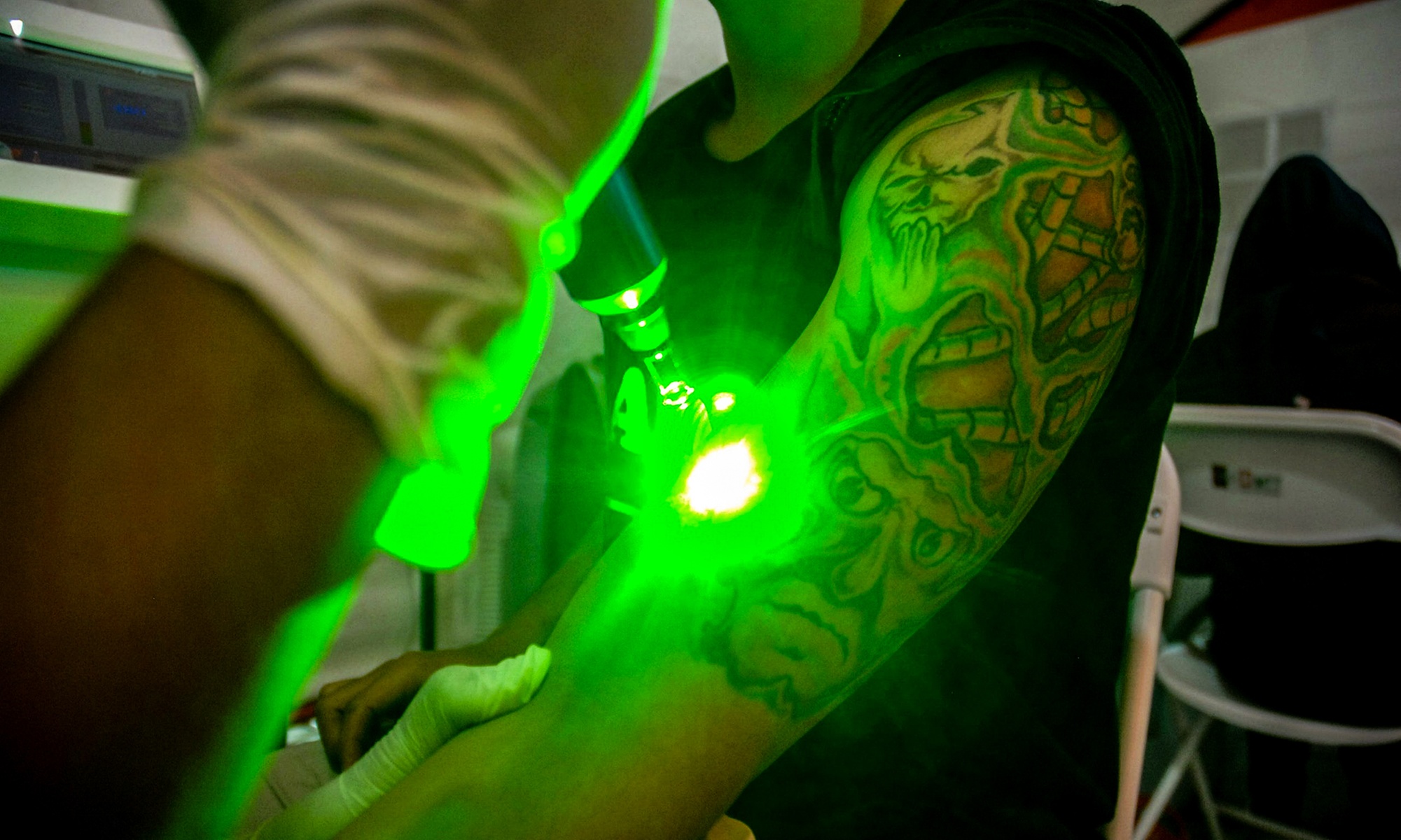 Erase Old Tattoo with One Session for Small, Medium, or Large Areas