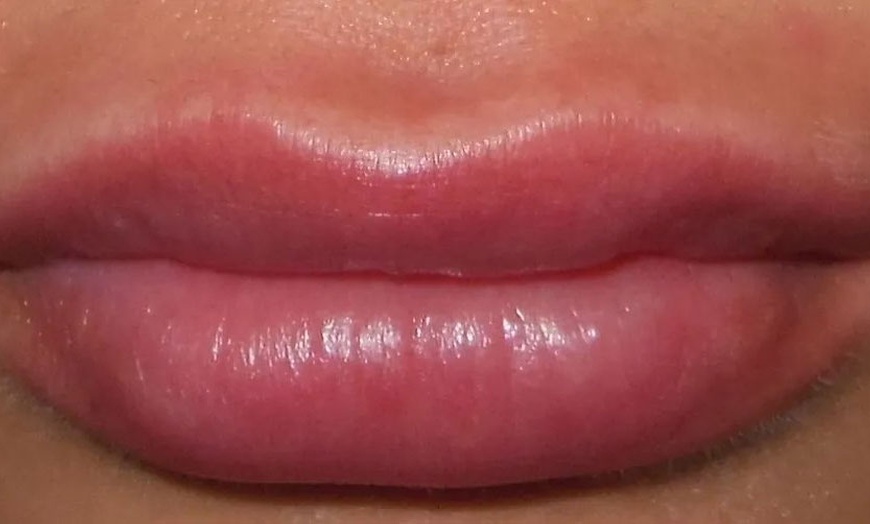 Image 2: 0.5, 1, or 2 ml Dermal Filler at Cosmetic Doctors