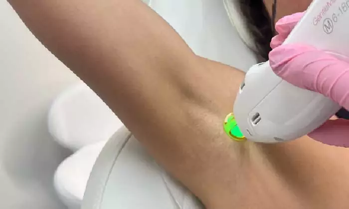 Six Laser Hair Removal Sessions of Your Chosen Area by Experts 