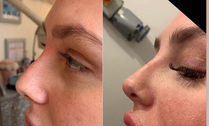 Image 1: One ml Nose Dermal Filler at Dolls Aesthetics - Harley Street