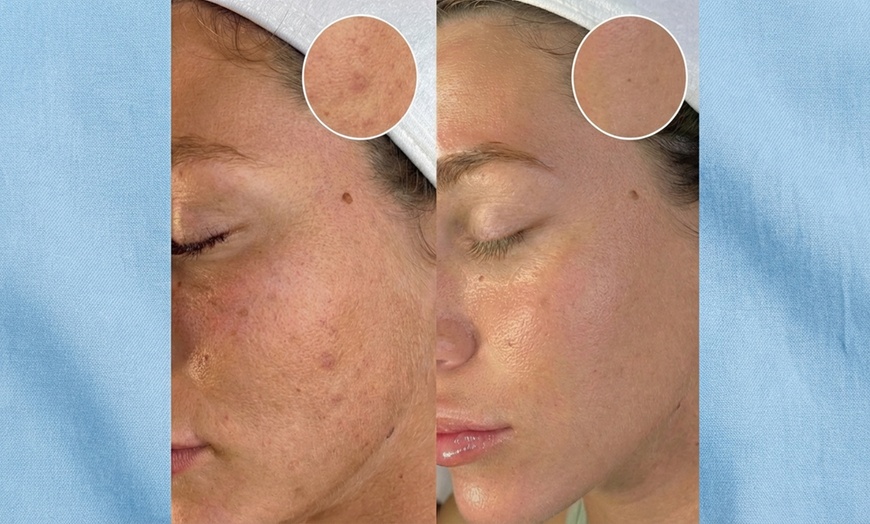Image 5: Revitalize with One, Three, or Six Sessions of Micro-needling