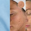 Image 5: Revitalize with One, Three, or Six Sessions of Micro-needling