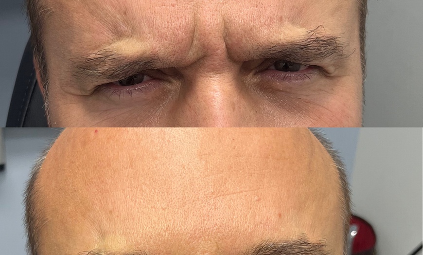 Image 2: Refresh Your Skin with 20, 40, or 60 Units of Neurotoxin