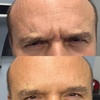 Image 2: Refresh Your Skin with 20, 40, or 60 Units of Neurotoxin