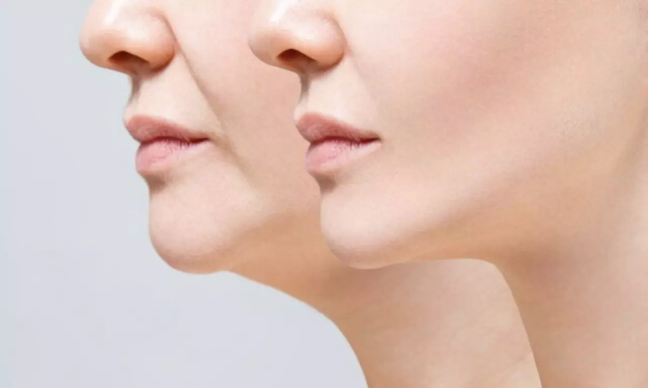 1 of 3x dubbele kin-cryolipolysebehandeling van 40 minuten