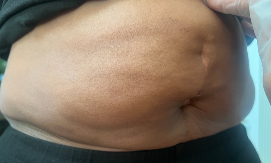 Image 1: Mobile Weight Management Cryotherapy 5 or 10 Sessions for Wellness

