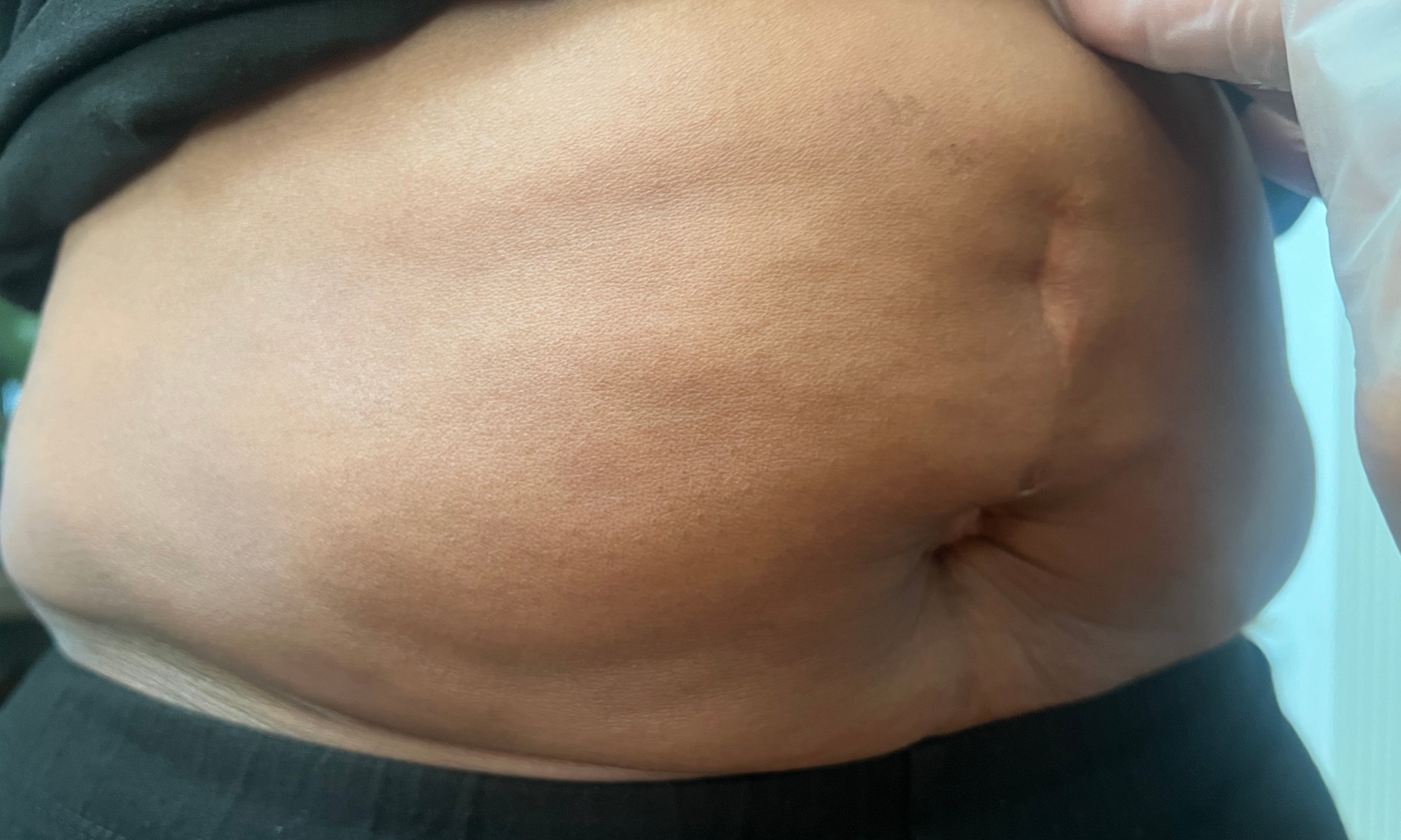 Mobile Weight Management Cryotherapy 5 or 10 Sessions for Wellness
