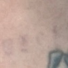Image 3: Up to 68% Laser Tattoo Removal