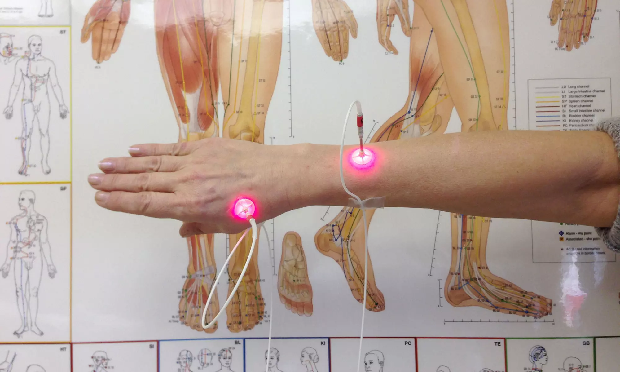Acupuncture Treatment and Initial Consultation For One or Two at Life Balance Clinic (Up to 77% Off) - Primary Image