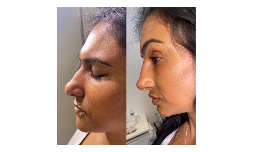 Image 3:  Perfect Contour with 1ml or 2ml Revolax Dermal Filler 