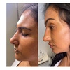Image 3:  Perfect Contour with 1ml or 2ml Revolax Dermal Filler 