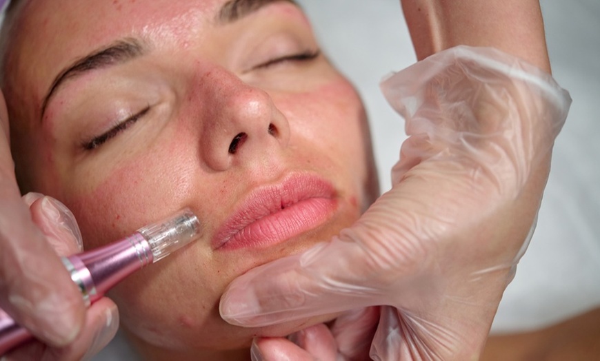 Image 2: Facial - Hydradermabrasion at Paradise aesthetics and nutrition clinic