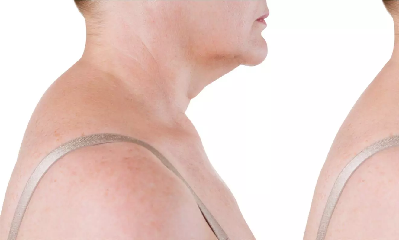 Achieve a sculpted look with Beauty By Design's sessions for hump back fat reduction, skin tightening using advanced technology, up to 33% off - Primary Image
