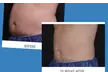 Complete 5-Month CoolSculpting Program Treatments for One at Elite Skin Studio's  - Up to 55% Off - Second Medium