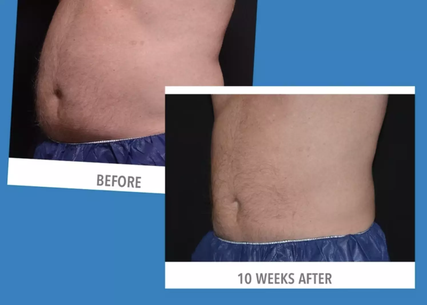 All-Inclusive CoolSculpting 5 Month Program -- One Price, Real Results!