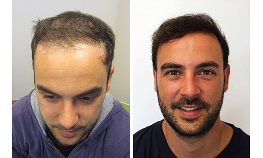 Image 6: Transform Your Look with 1000, 2000, or 3000 Graft Transplant