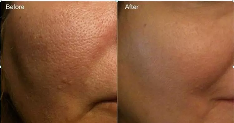 Rejuvenate with One Black Carbon Laser Treatment for Healthier Skin