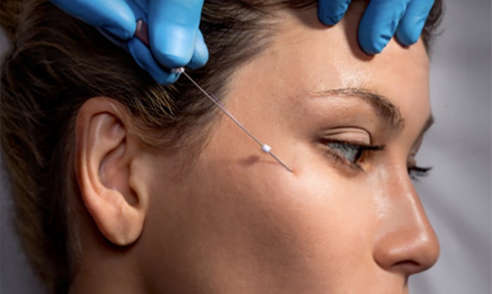 Thread Lifts for Jawline, Midface, Neck & Knee Areas
