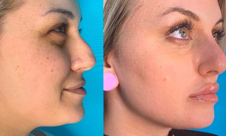 Image 2: Unveil a New You: Special Pricing on Botox and Juvederm!