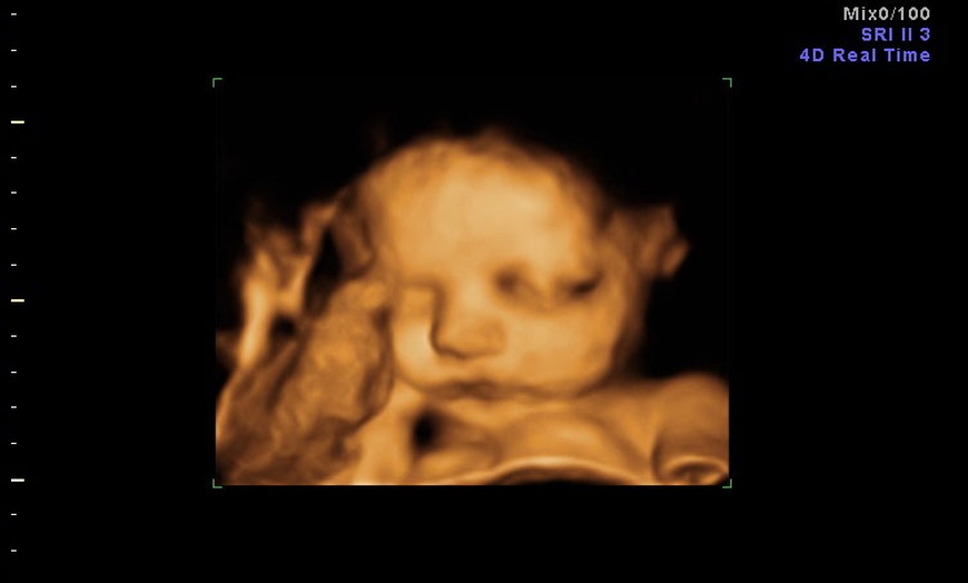 Image 9: 3D/ 4D Baby Scan