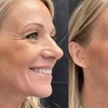 Image 5: Get a Smoother Look with Botox for Frown Lines or Crows Feet