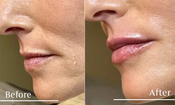 Explore YOUNIQUE Self's lip and facial fillers, including lips, cheeks, chin options with up to 54% discount - Second Medium