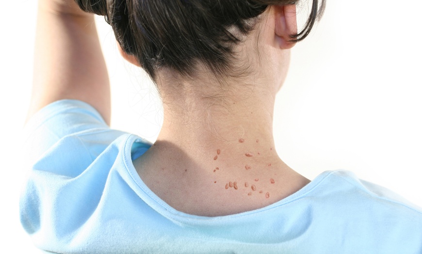 Image 4: Bioclear Skin Tag Patches