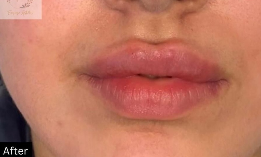 Image 7: 1ml or 2ml Filler for Lips, Russian Lips, Jawline, Chin or Cheek 