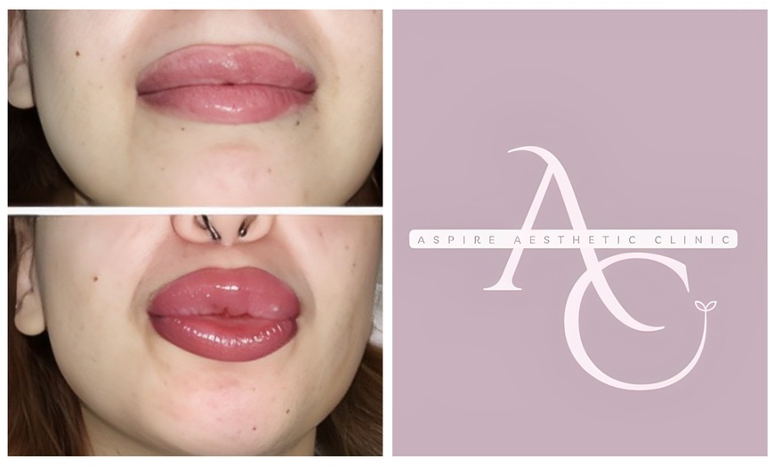 Image 4: Enhance your Lips with Expert Dermal Filler Treatments in Wembley!