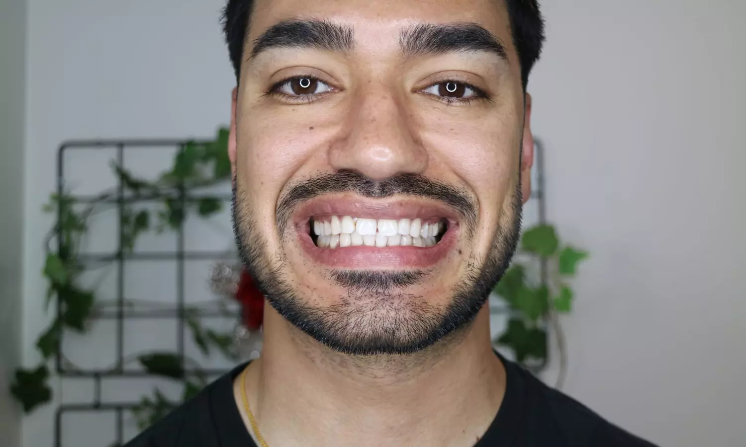 Premium 60-Minute Teeth Whitening at Smile Labs Penrith