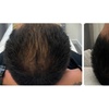 Image 5: Fuller & Healthier Scalp: 2, 4, or 6 Procell Hair Restoration Sessions