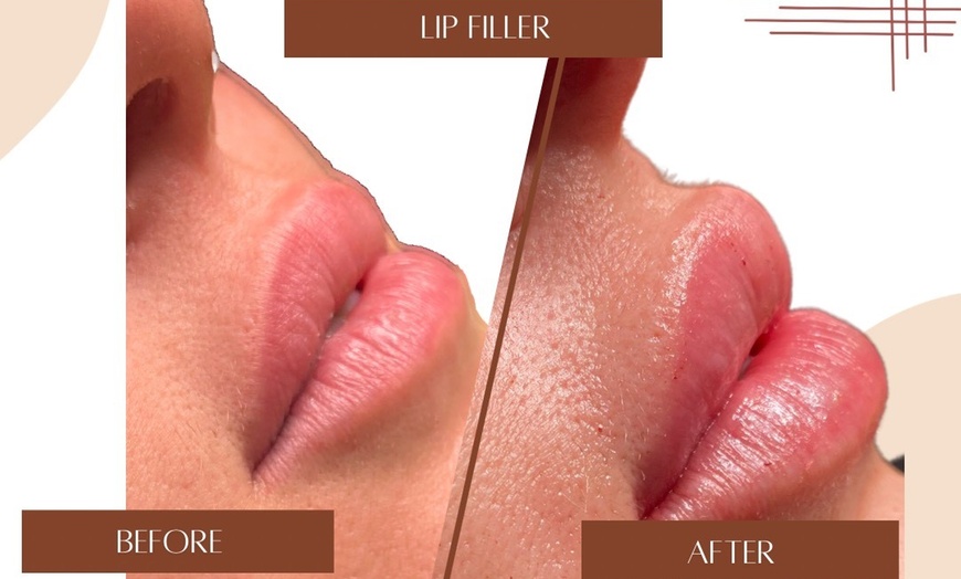 Image 2: Define Your Lips with Expertly Applied 0.5ml or 1ml Dermal Filler 