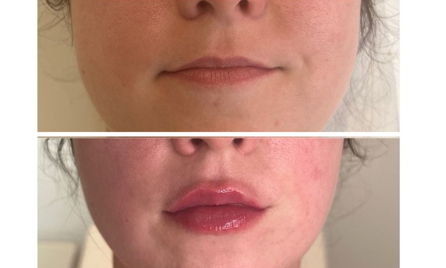Image 6: 0.5, 1 or 2ml Dermal Filler w/ Consultation: Lip, Smile, Cheek or Chin