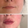 Image 6: 0.5, 1 or 2ml Dermal Filler w/ Consultation: Lip, Smile, Cheek or Chin