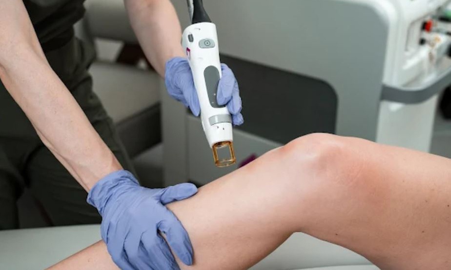 6 Candela Laser Sessions for Smooth, Hair-Free Skin