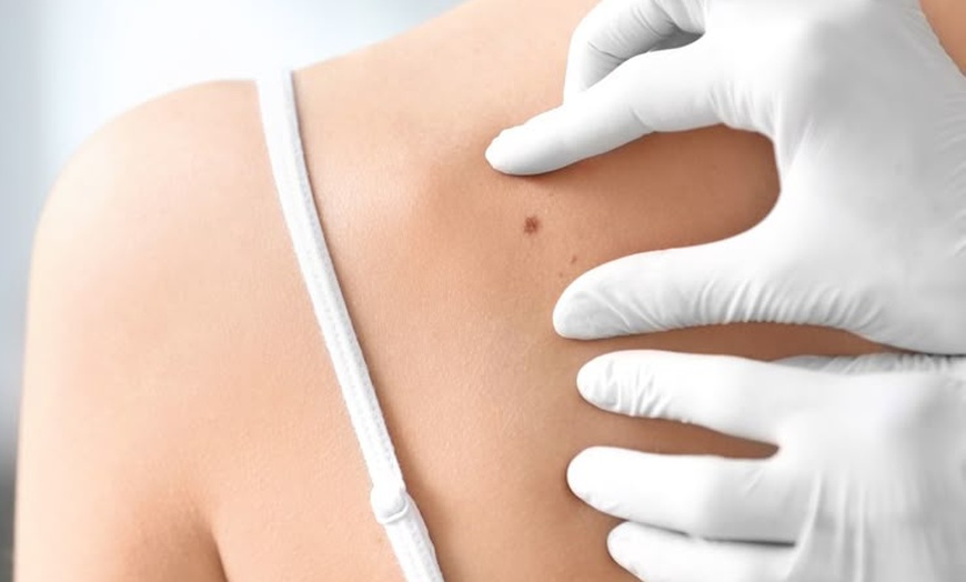 Image 4: Get clear skin with the removal treatment of moles, warts, skin tags, or brown spots at LuminUs at Boudica.