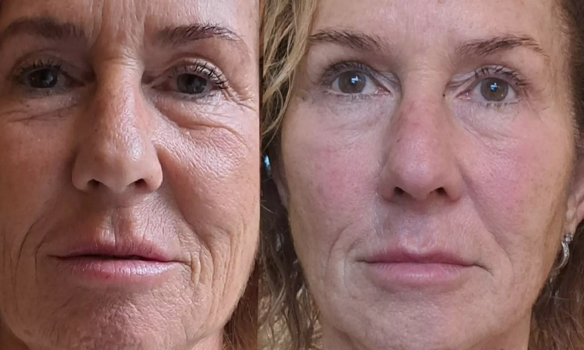 Recente HIFU 22D 2026 Facelift Zonder Snijden en gezichtsbehandeling
