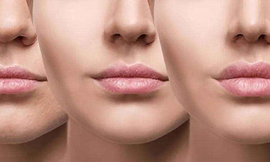 Image 4: Hyaluronpen con hidratación o relleno de labios y reafirmación facial