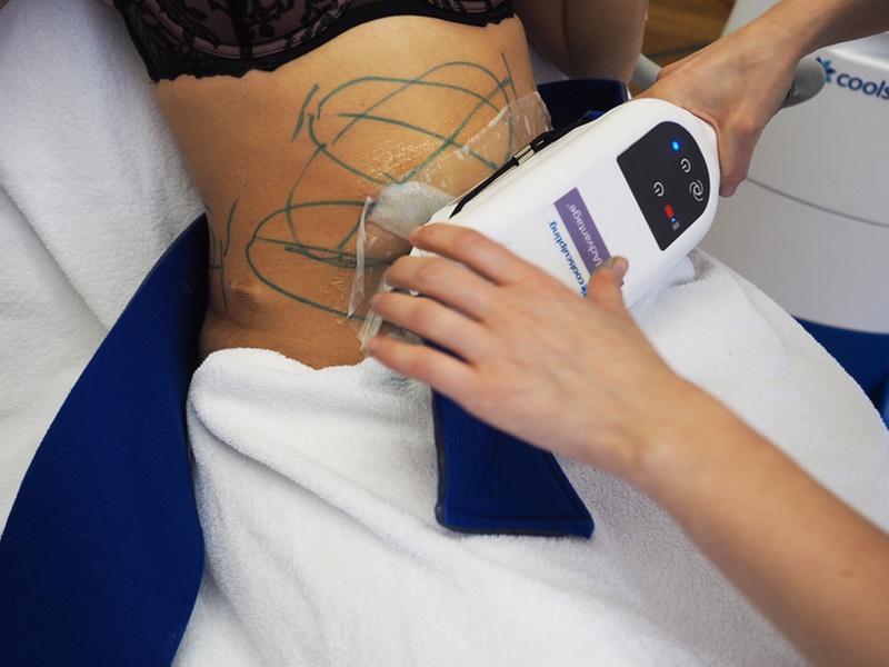 Coolsculpting Sessions for Fat Reduction with No Downtime